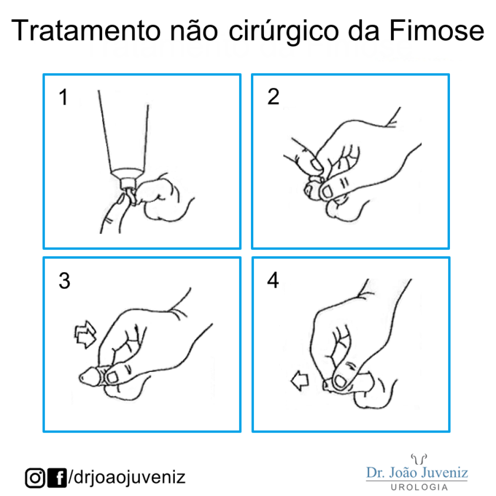 Dr Joao Juveniz Tratamento Nao Cirurgico Da Fimose Dr Jo O Juveniz